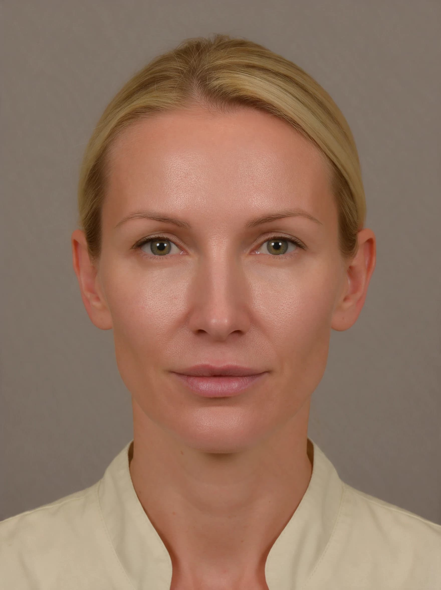Dermal Fillers — AI simulated consultation view after