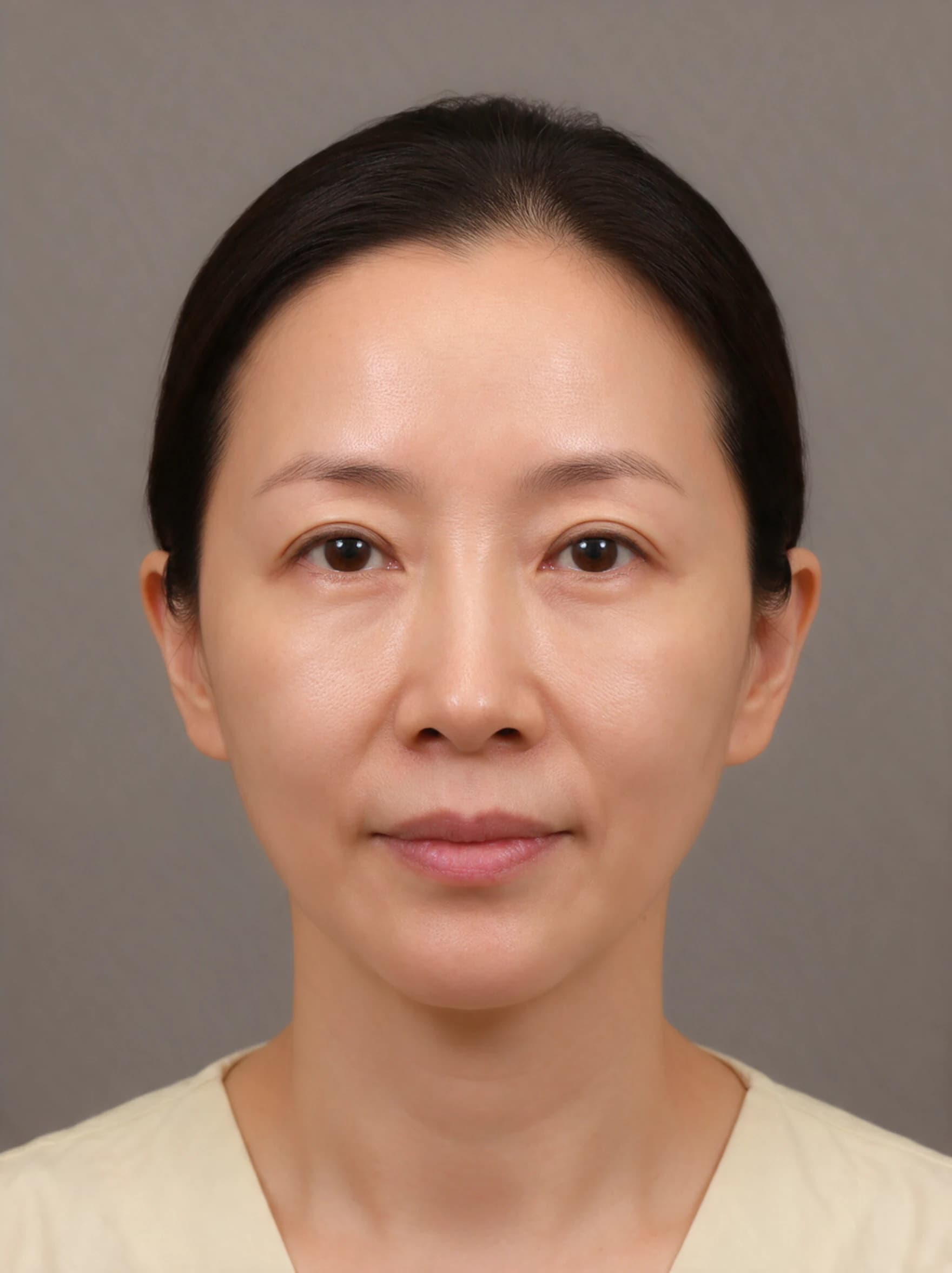 Ultherapy Prime — AI simulated consultation view after